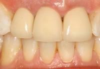 pre-treatment 